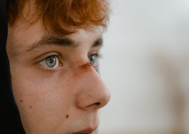 蒜頭鼻改善的專業知識分享